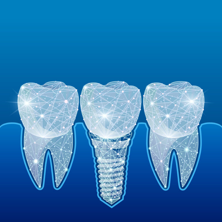 Healthy,Teeth,And,Dental,Implant.,Dentistry.,Implantation,Of,Human,Teeth