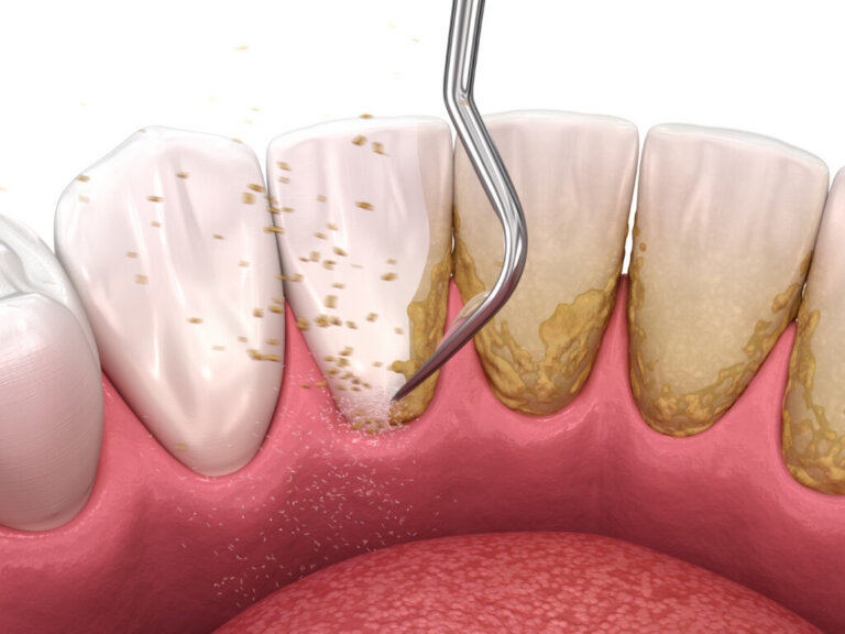 Oral,Hygiene:,Scaling,And,Root,Planing,(conventional,Periodontal,Therapy)