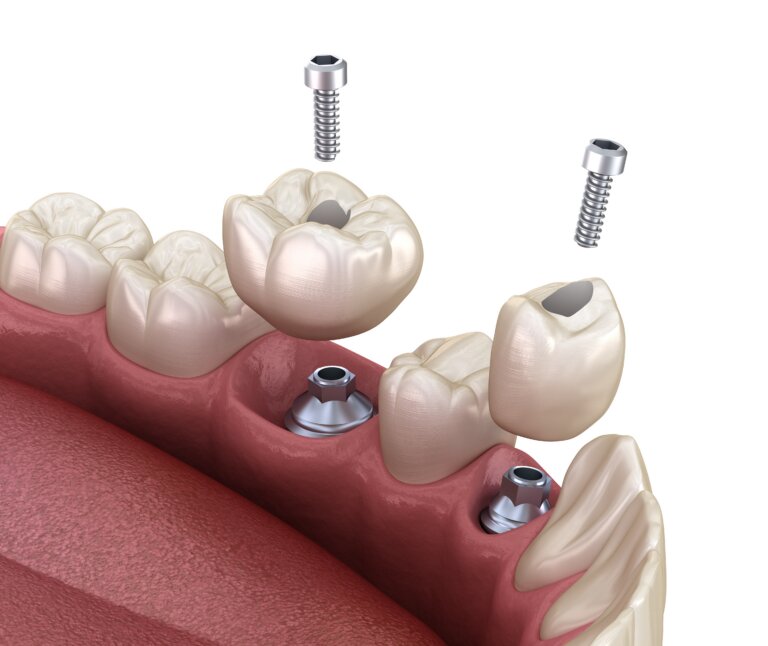 Premolar,And,Molar,Tooth,Crown,Installation,Over,Implant,,Screw,Fixation